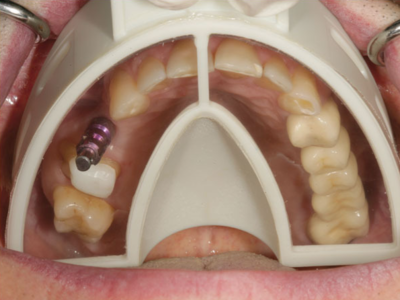 MIRATRAY Implant odtisne žlice